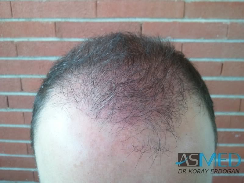 Norwood5 3231-grafts-FUE bd4e3e31