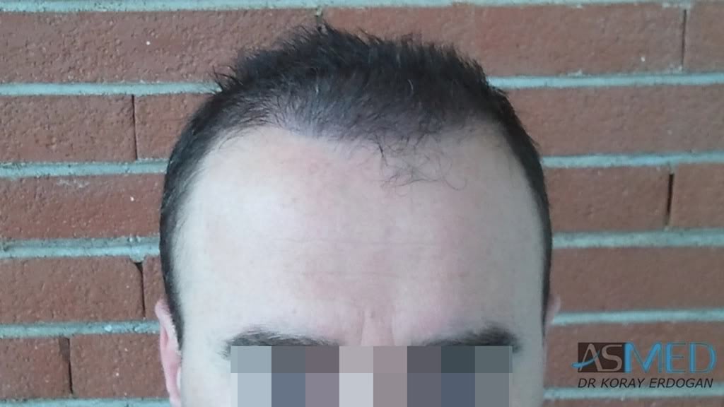 Norwood5 3231-grafts-FUE c2f7a8fa