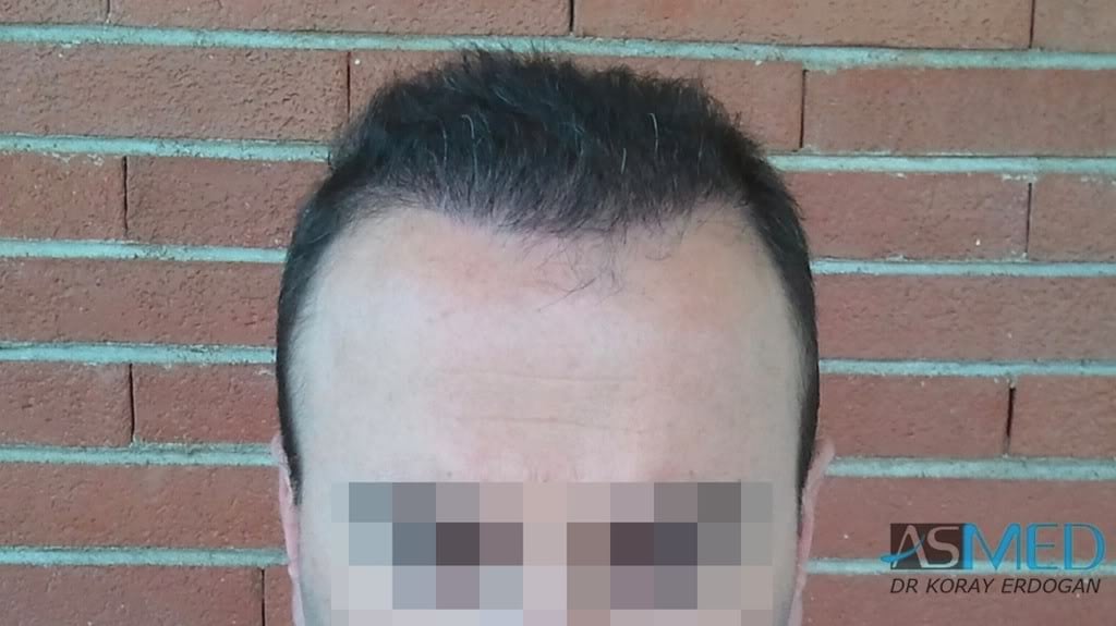 Norwood5 3231-grafts-FUE d606dd94
