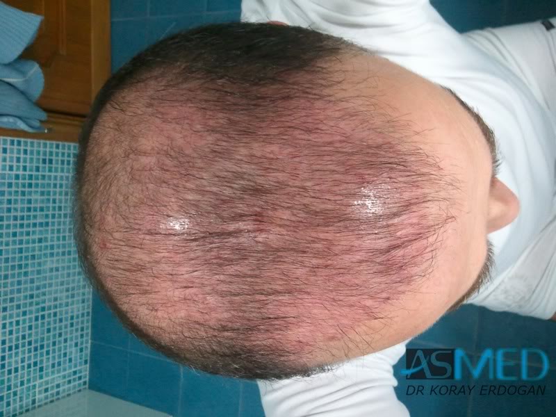 Norwood5 3231-grafts-FUE e528b1e3