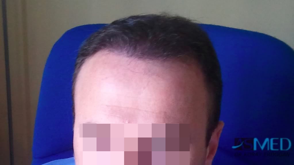 Norwood5 3231-grafts-FUE e7ccfc34