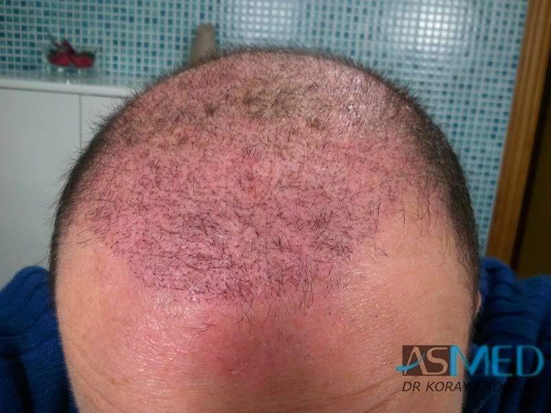 Norwood5 3231-grafts-FUE ec86646c