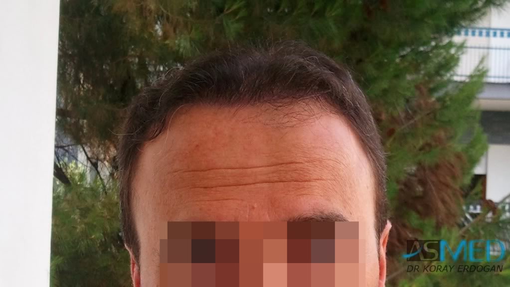 Norwood5 3231-grafts-FUE f83b8dc7