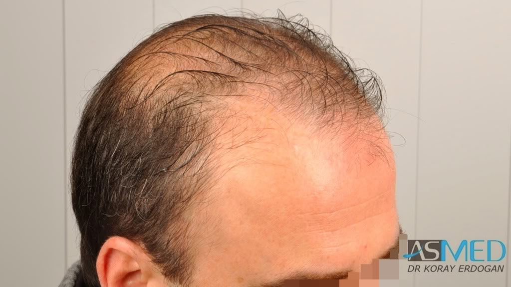 Norwood5 3231-grafts-FUE f8f6741c
