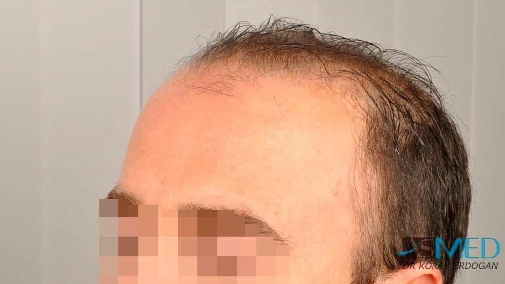 Norwood5 3231-grafts-FUE f92b3d0e