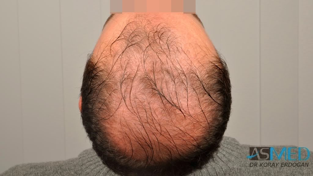 Norwood5 3231-grafts-FUE fd6ae36f