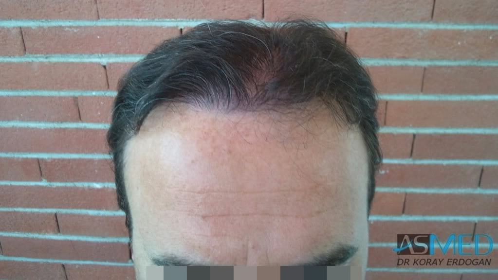Norwood5 3231-grafts-FUE file-1