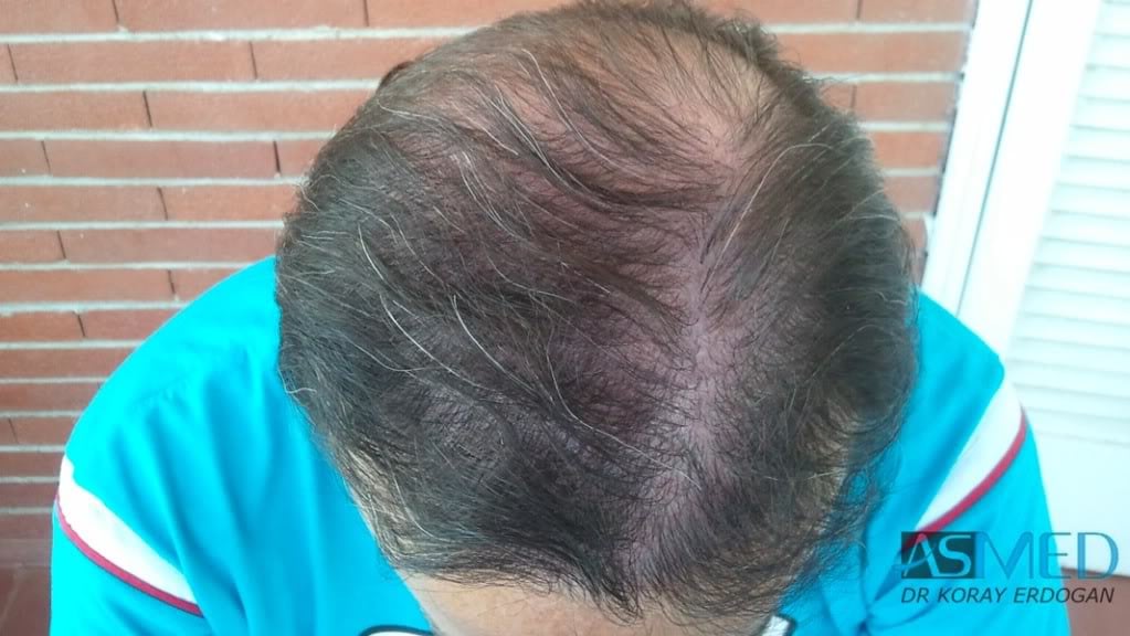 Norwood5 3231-grafts-FUE file-2