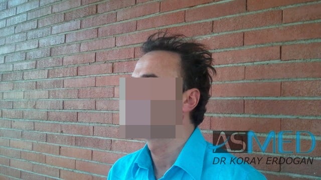 Norwood5 3231-grafts-FUE file-3