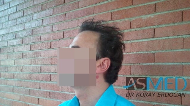 Norwood5 3231-grafts-FUE file-4