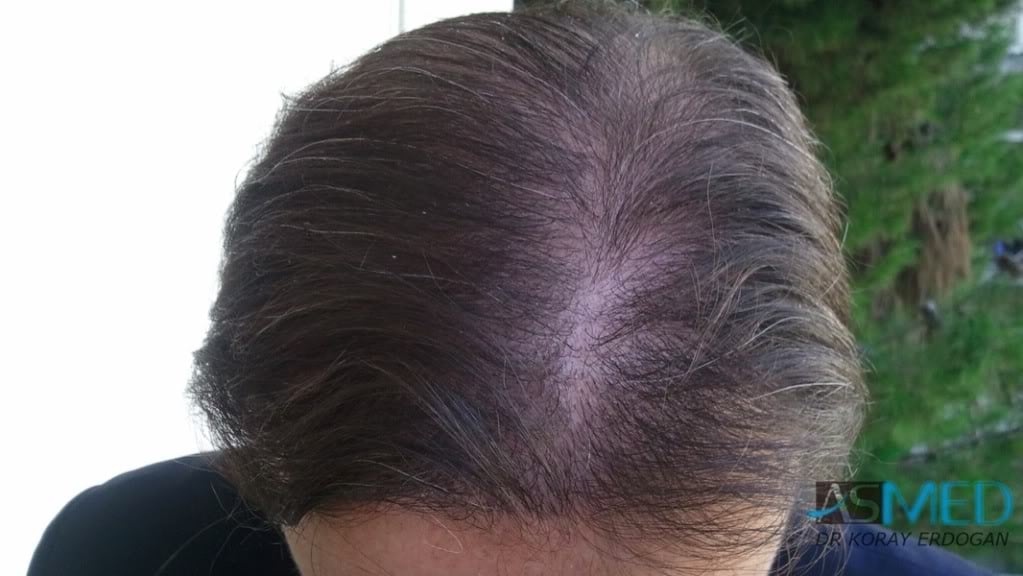 Norwood5 3231-grafts-FUE file-5