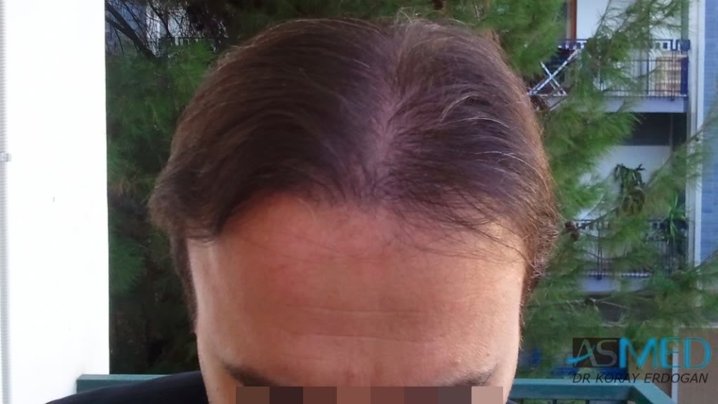 Norwood5 3231-grafts-FUE file-6
