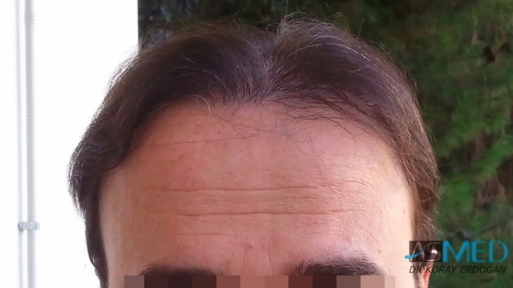 Norwood5 3231-grafts-FUE file-7