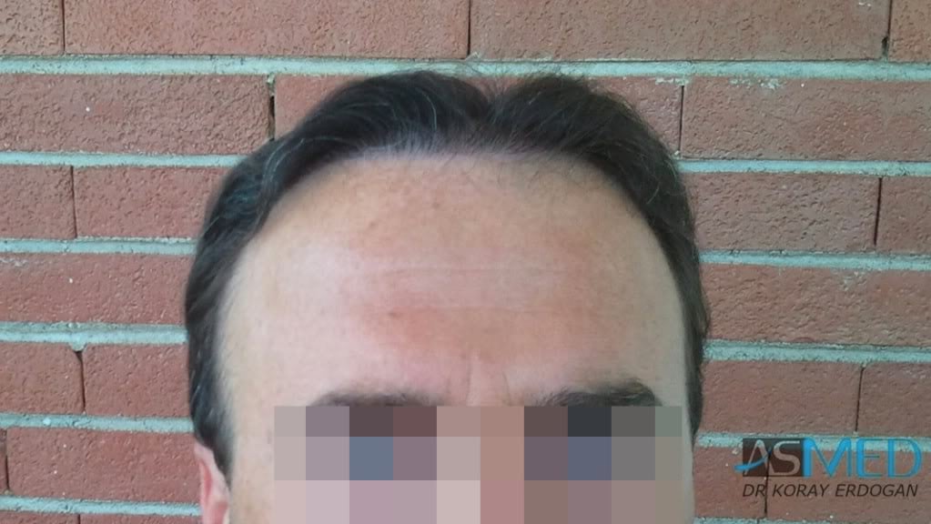 Norwood5 3231-grafts-FUE file