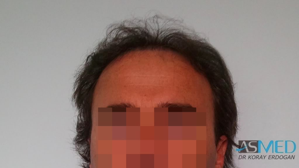 Norwood5 3231-grafts-FUE file_zps1dcfb5ea