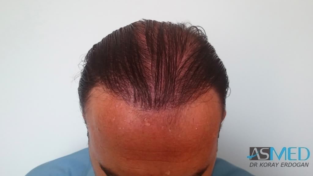 Norwood5 3231-grafts-FUE file_zps393df27c