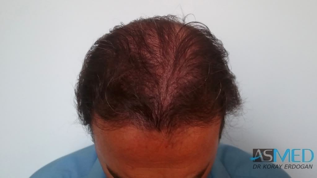Norwood5 3231-grafts-FUE file_zps73cefd80