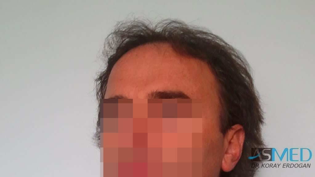Norwood5 3231-grafts-FUE file_zps8aa72564
