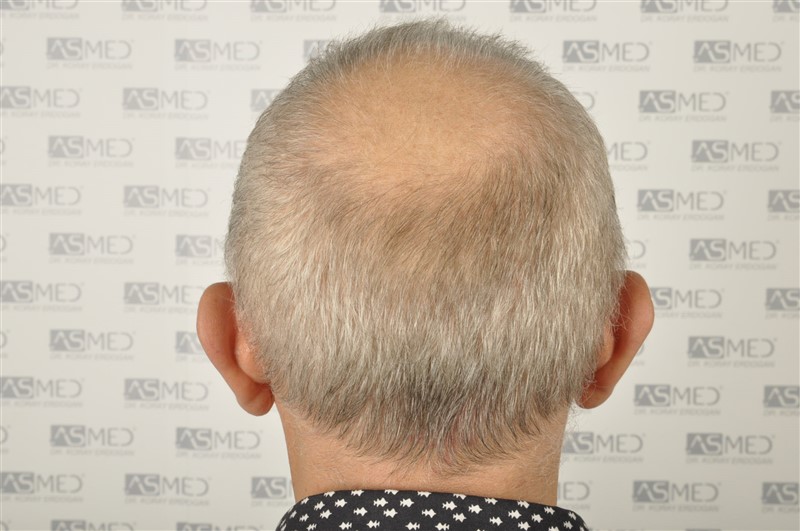 https://www.hairtransplantfue.org/asmed-hair-transplant-result/upload/Norwood5/4005-grafts-FUE/1FUE/2years/_DSC2917.jpg