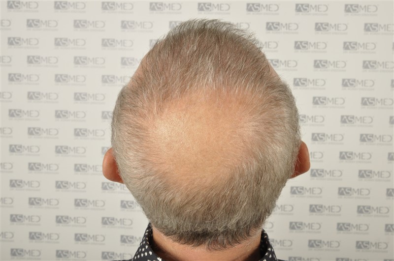 https://www.hairtransplantfue.org/asmed-hair-transplant-result/upload/Norwood5/4005-grafts-FUE/1FUE/2years/_DSC2921.jpg