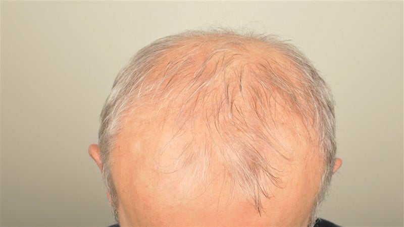 https://www.hairtransplantfue.org/asmed-hair-transplant-result/upload/Norwood5/4005-grafts-FUE/1FUE/before/_DSC6155.jpg