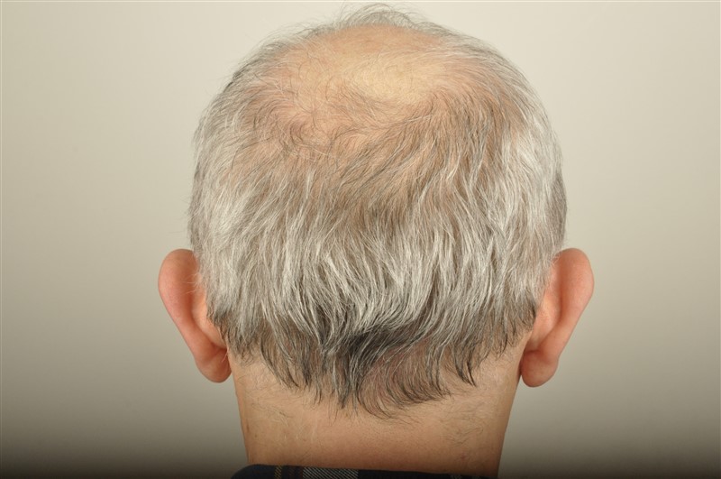 https://www.hairtransplantfue.org/asmed-hair-transplant-result/upload/Norwood5/4005-grafts-FUE/1FUE/before/_DSC6161.jpg