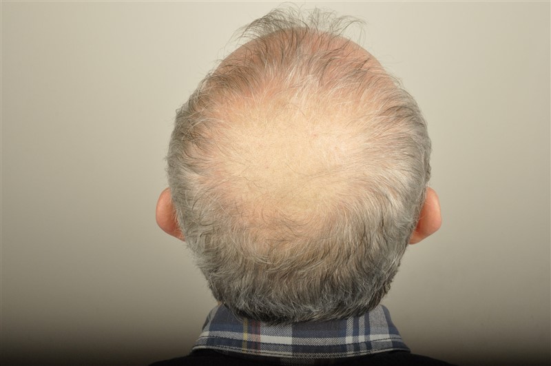 https://www.hairtransplantfue.org/asmed-hair-transplant-result/upload/Norwood5/4005-grafts-FUE/1FUE/before/_DSC6172.jpg