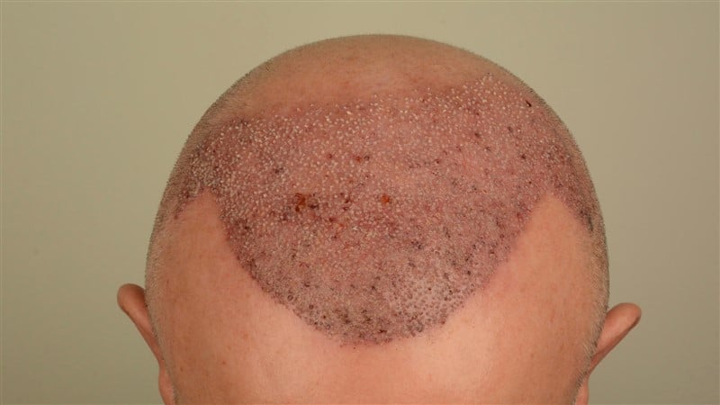 https://www.hairtransplantfue.org/asmed-hair-transplant-result/upload/Norwood5/4005-grafts-FUE/1FUE/operation/DSC_7965.jpg