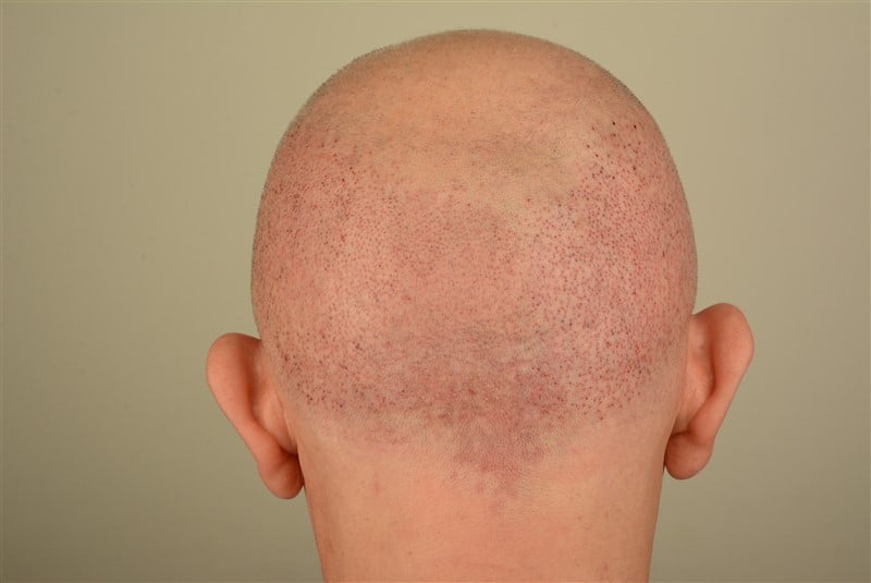https://www.hairtransplantfue.org/asmed-hair-transplant-result/upload/Norwood5/4005-grafts-FUE/1FUE/operation/DSC_7971.jpg