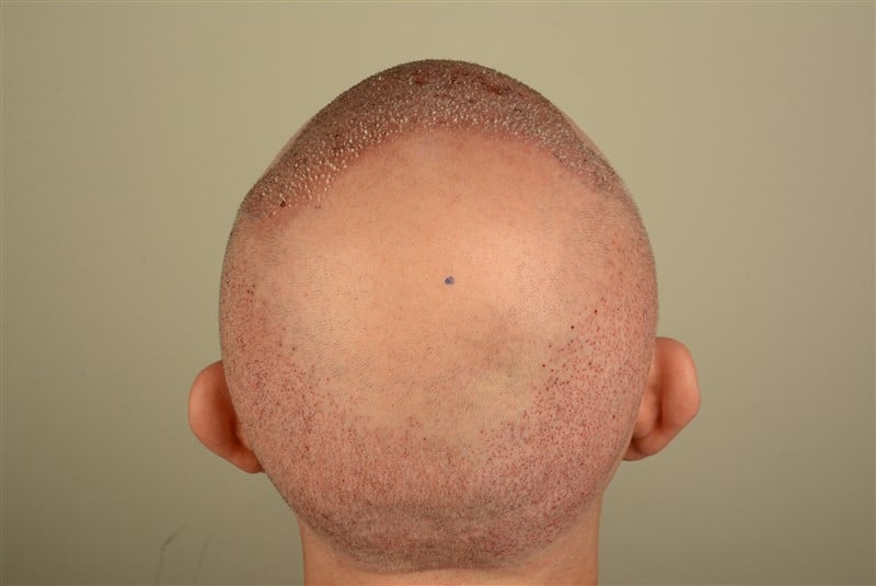 https://www.hairtransplantfue.org/asmed-hair-transplant-result/upload/Norwood5/4005-grafts-FUE/1FUE/operation/DSC_7974.jpg