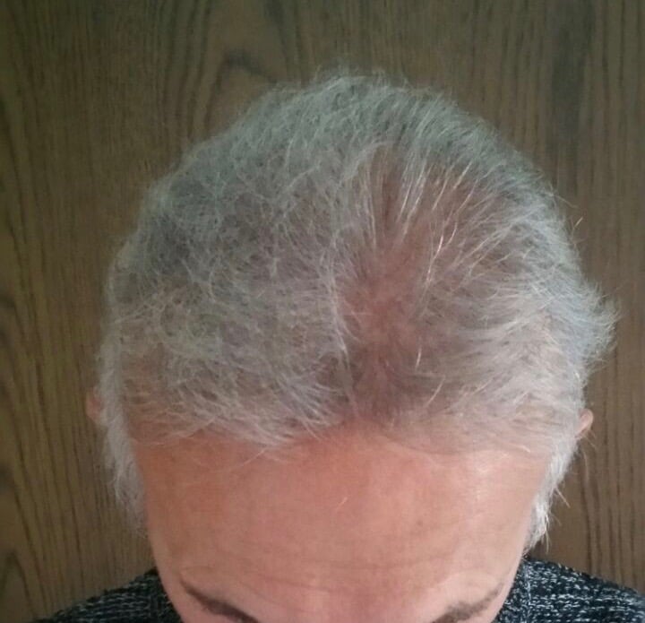 https://www.hairtransplantfue.org/asmed-hair-transplant-result/upload/Norwood5/4005-grafts-FUE/2FUE/6months/2%202.jpg