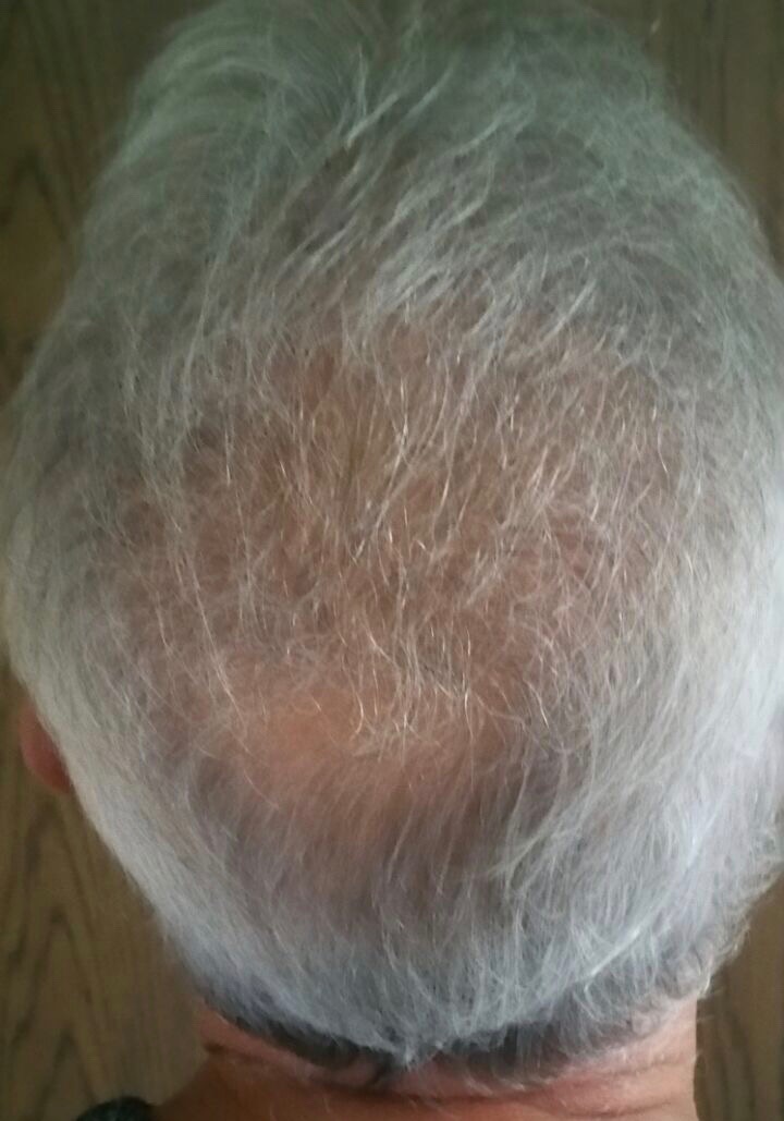 https://www.hairtransplantfue.org/asmed-hair-transplant-result/upload/Norwood5/4005-grafts-FUE/2FUE/6months/3%202.jpg