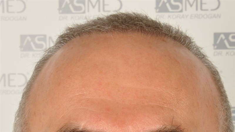 https://www.hairtransplantfue.org/asmed-hair-transplant-result/upload/Norwood5/4005-grafts-FUE/2FUE/before/_DSC2910.jpg