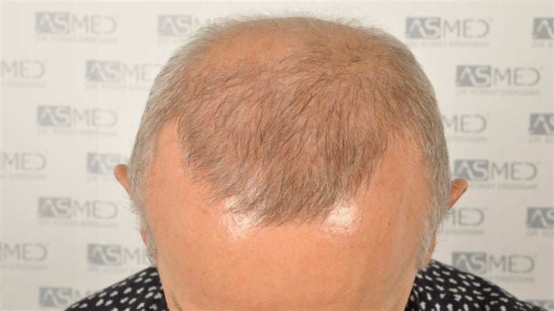 https://www.hairtransplantfue.org/asmed-hair-transplant-result/upload/Norwood5/4005-grafts-FUE/2FUE/before/_DSC2911.jpg