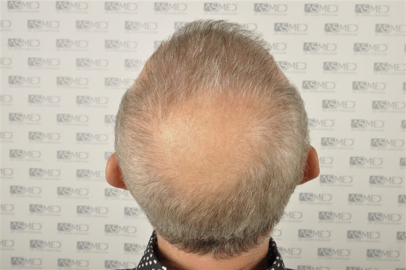 https://www.hairtransplantfue.org/asmed-hair-transplant-result/upload/Norwood5/4005-grafts-FUE/2FUE/before/_DSC2921.jpg