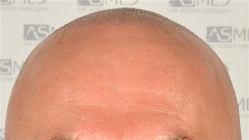 https://www.hairtransplantfue.org/asmed-hair-transplant-result/upload/Norwood5/4005-grafts-FUE/2FUE/operation/_DSC3252.jpg