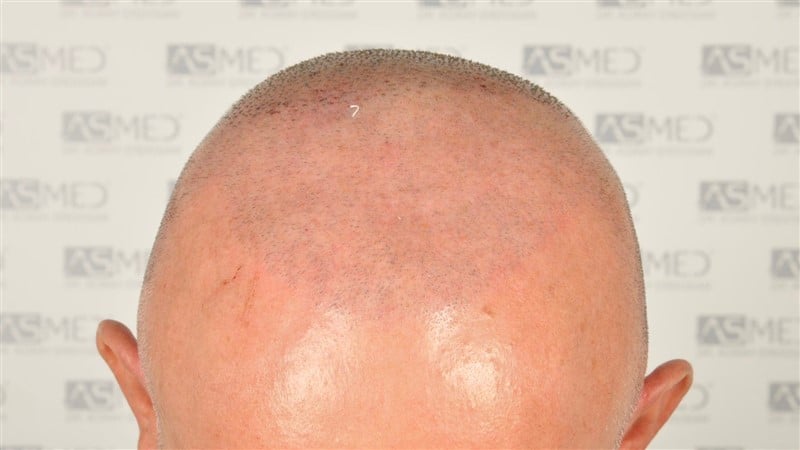 https://www.hairtransplantfue.org/asmed-hair-transplant-result/upload/Norwood5/4005-grafts-FUE/2FUE/operation/_DSC3253.jpg