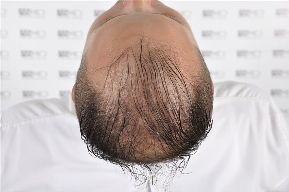 Norwood5 4050-grafts-FUE before 1