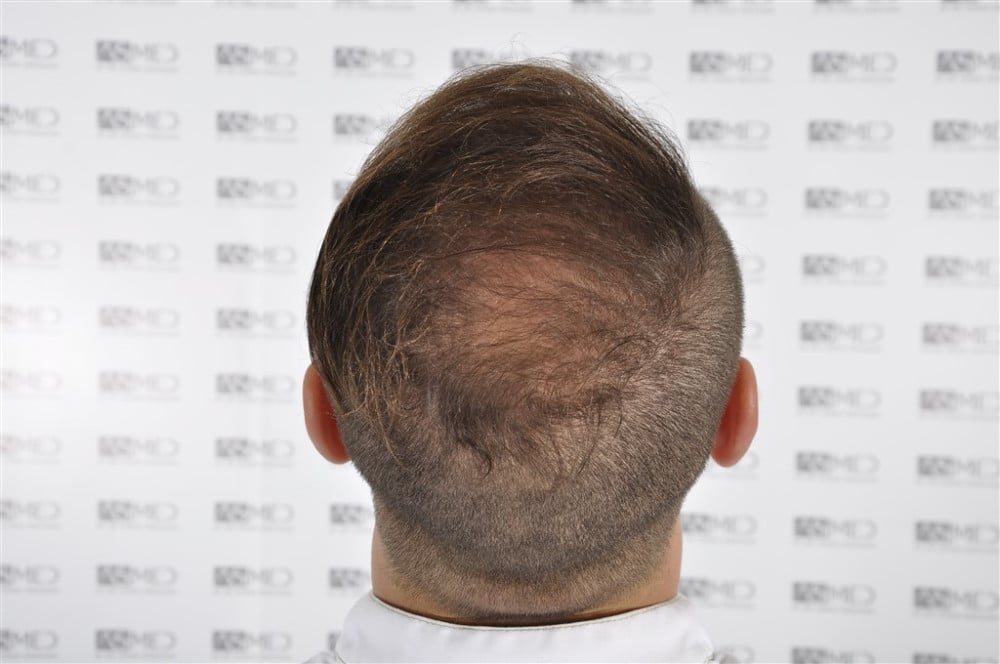 Norwood5 4050-grafts-FUE before _DSC3353