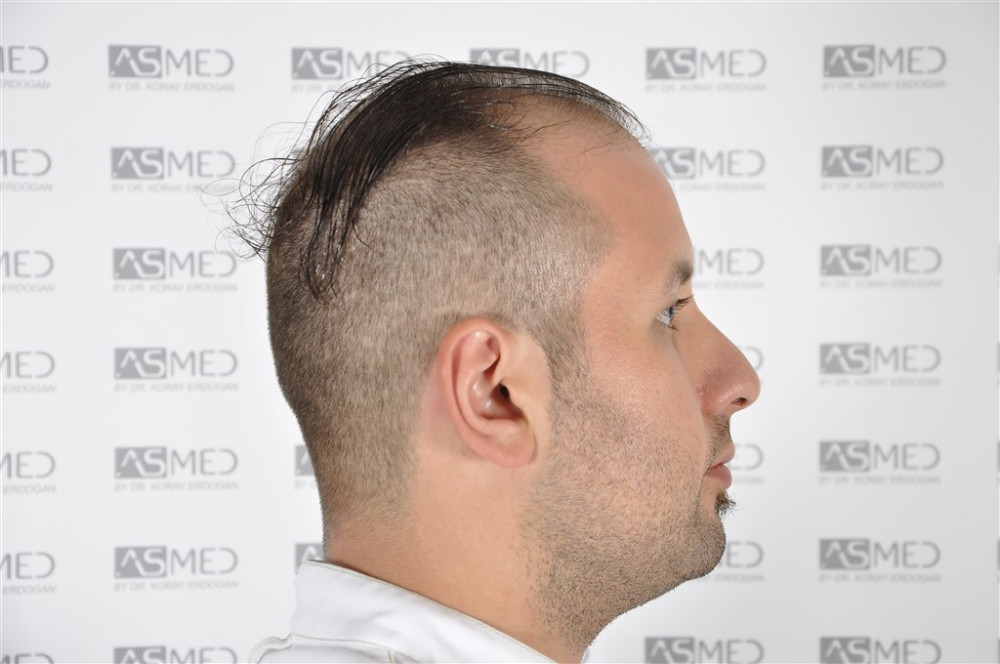 Norwood5 4050-grafts-FUE before _DSC3356