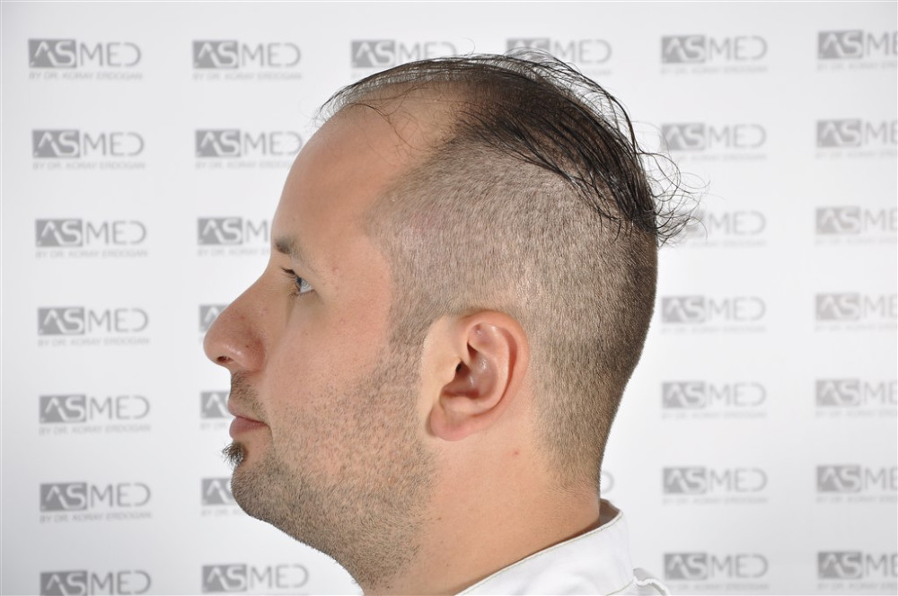 Norwood5 4050-grafts-FUE before _DSC3357