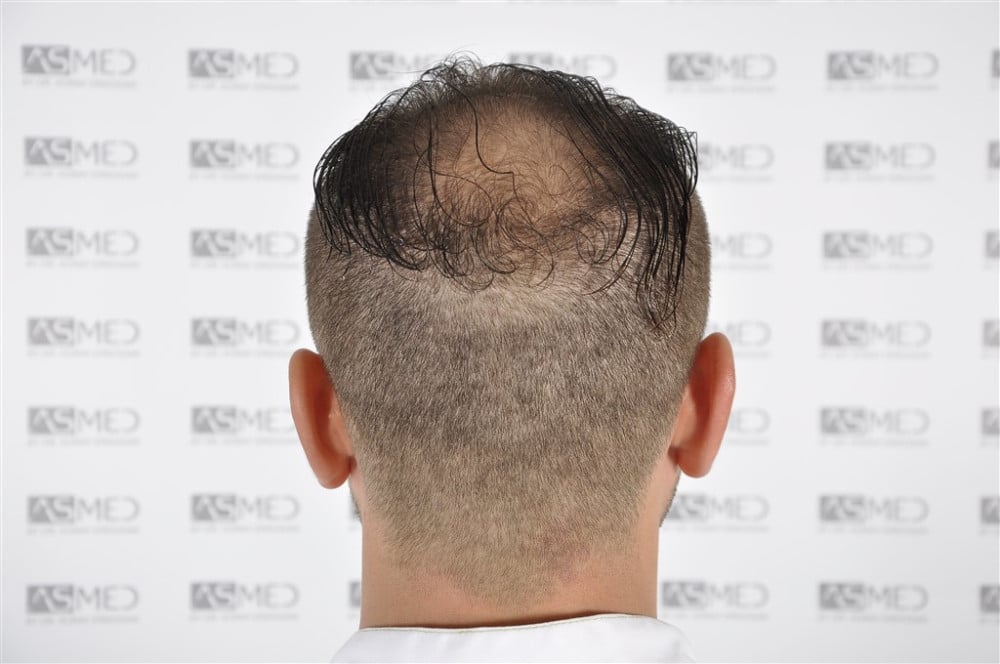 Norwood5 4050-grafts-FUE before _DSC3358