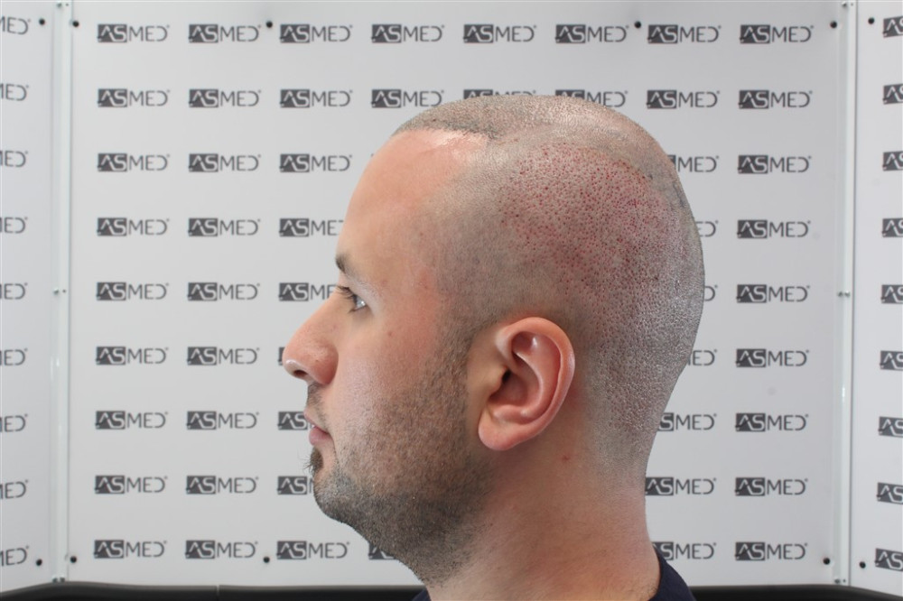 Norwood5 4050-grafts-FUE operation 17747_Sol