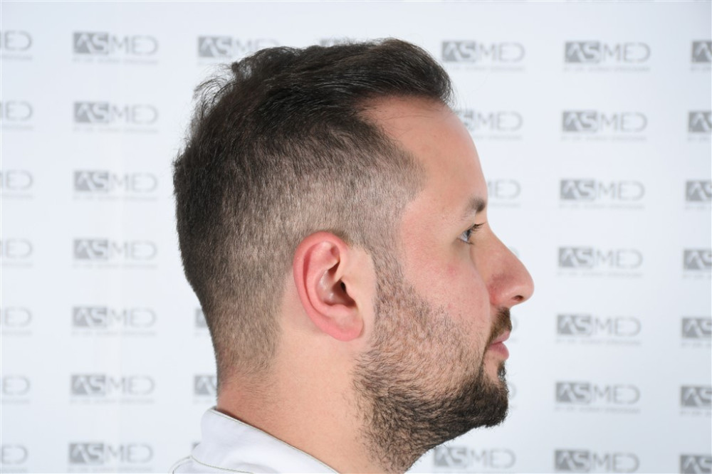 Norwood5 4050-grafts-FUE result DSC_2506