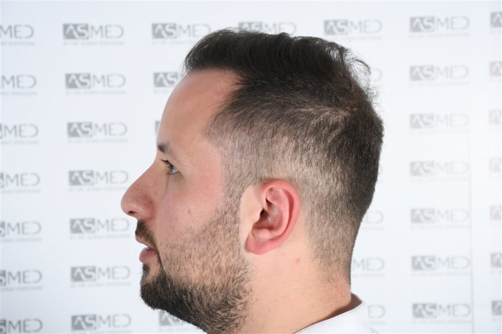 Norwood5 4050-grafts-FUE result DSC_2507