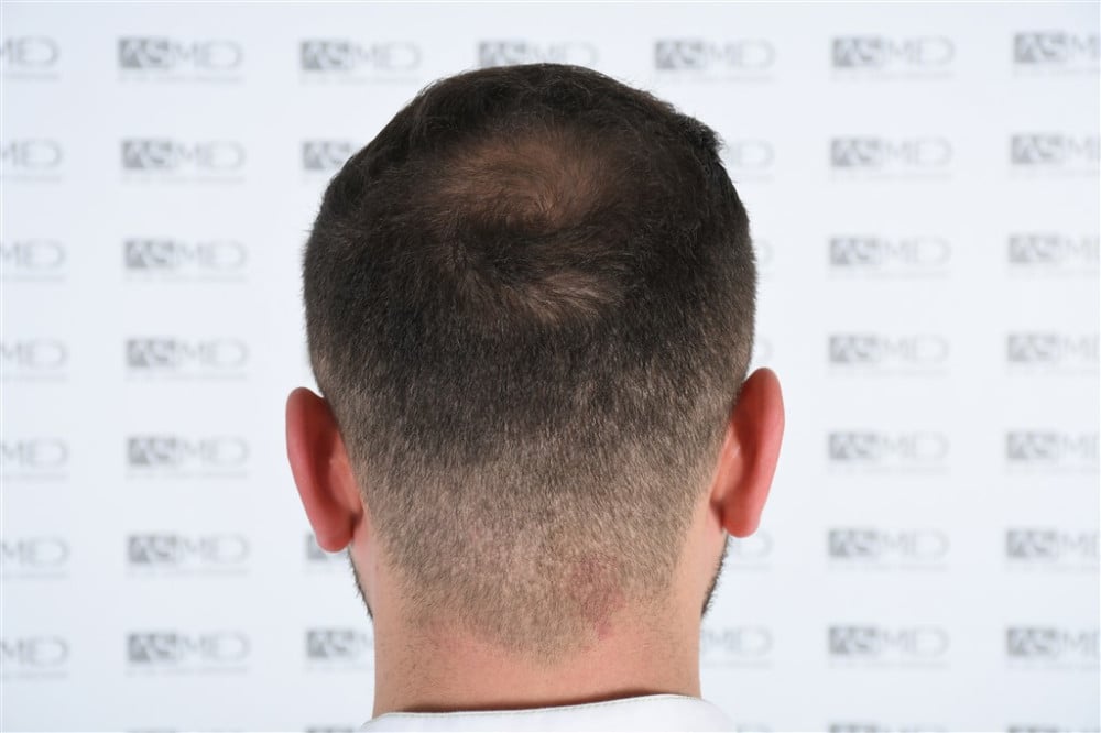 Norwood5 4050-grafts-FUE result DSC_2508