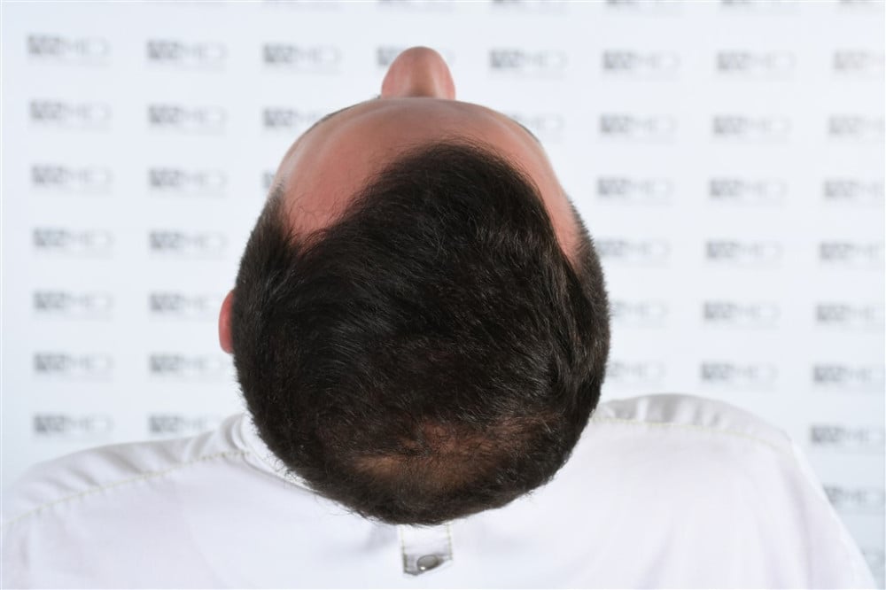 Norwood5 4050-grafts-FUE result DSC_2509