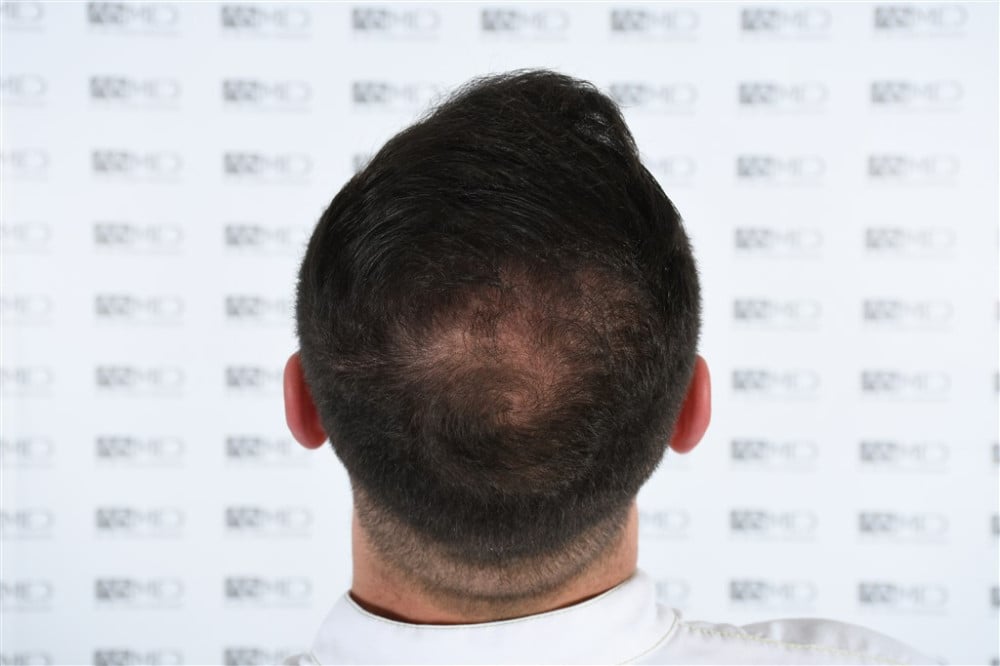 Norwood5 4050-grafts-FUE result DSC_2510