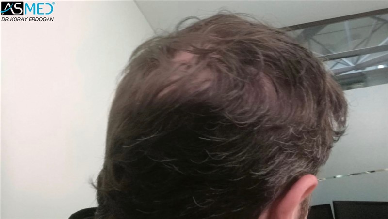 Norwood5 4214-grafts-FUE 6months AFT2