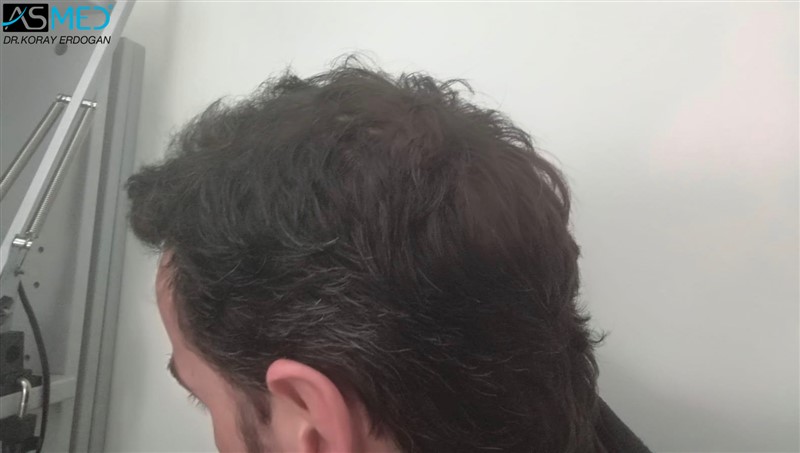 Norwood5 4214-grafts-FUE 6months AFT3